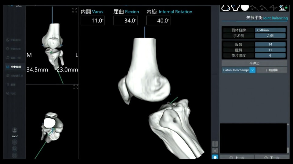 Why Patellar Simulation Matters in TKA – And How It Improves Patient Outcomes